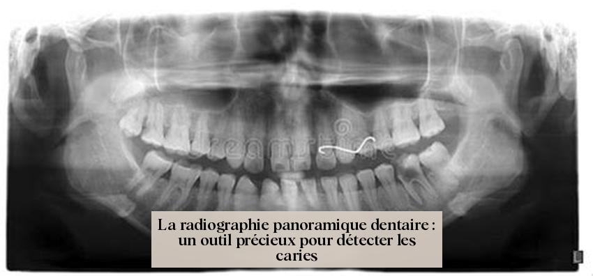 La radiographie panoramique dentaire : un outil précieux pour détecter les caries