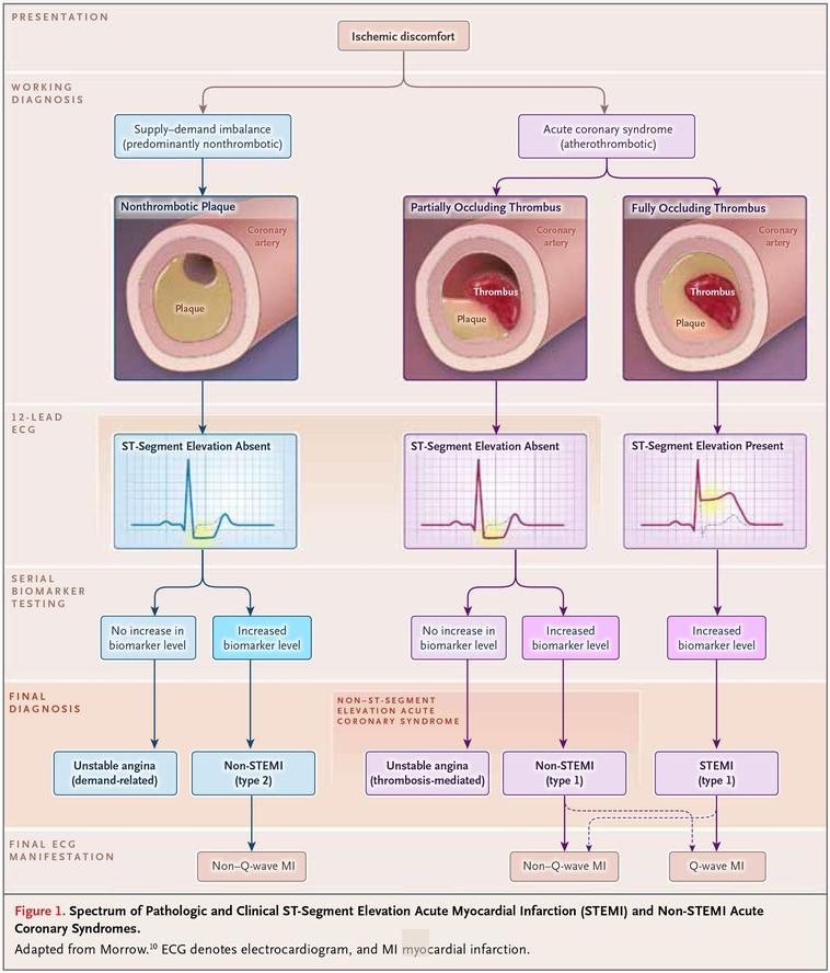 Diagnostic and Prognosis of Myocardial Infarction