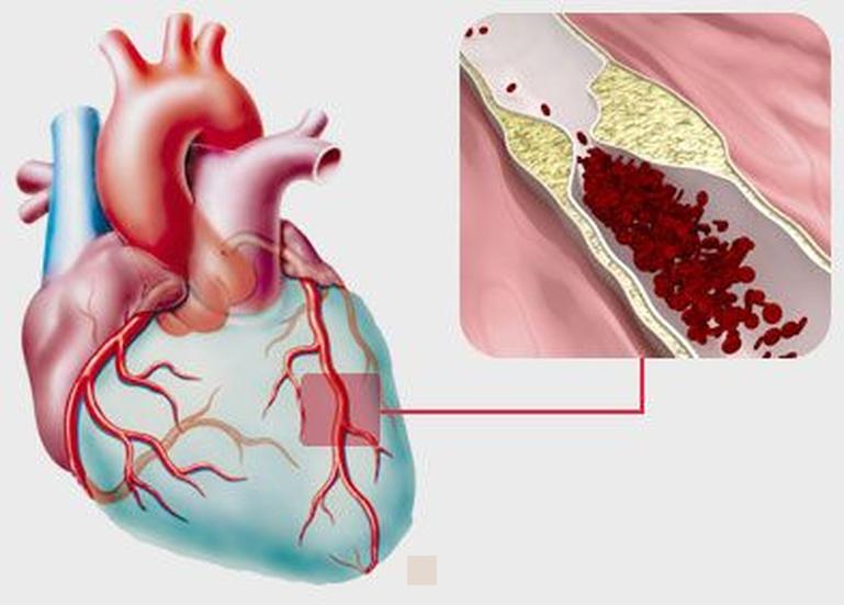 Infarctus du myocarde: Urgence cardiaque